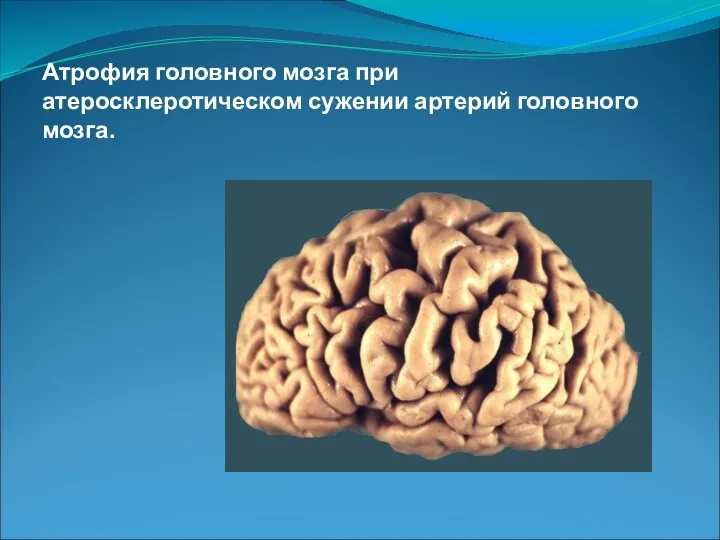 Атрофия головного мозга при атеросклеротическом сужении артерий головного мозга.