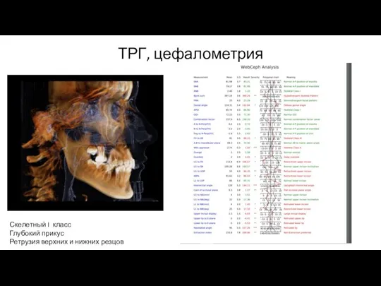 ТРГ, цефалометрия Скелетный I класс Глубокий прикус Ретрузия верхних и нижних резцов