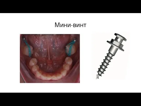 Мини-винт