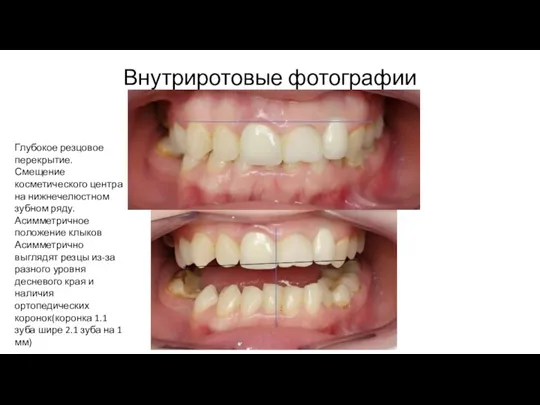 Внутриротовые фотографии Глубокое резцовое перекрытие. Смещение косметического центра на нижнечелюстном