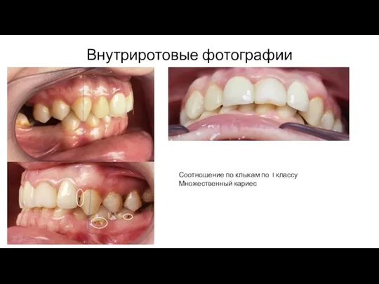 Внутриротовые фотографии Соотношение по клыкам по I классу Множественный кариес