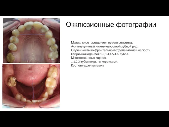 Окклюзионные фотографии Мезиальное смещение первого сегмента. Асимметричный нижнечелюстной зубной ряд.