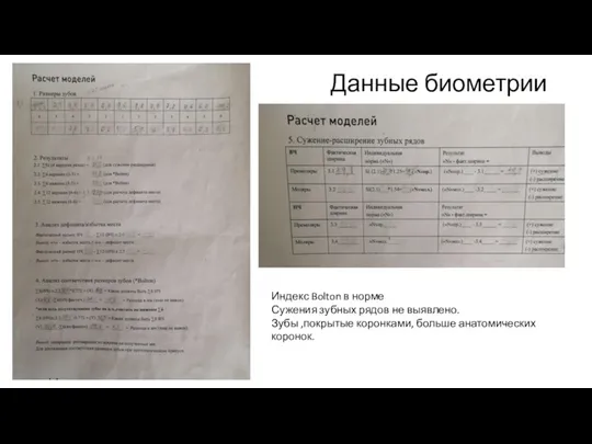 Данные биометрии Индекс Bolton в норме Сужения зубных рядов не