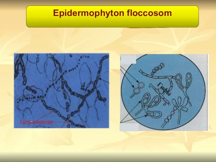 Epidermophyton floccosom