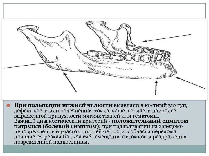 При пальпации нижней челюсти выявляется костный выступ, дефект кости или
