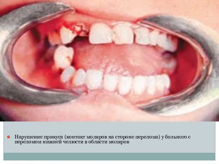 Нарушение прикуса (контакт моляров на стороне перелома) у больного с переломом нижней челюсти в области моляров