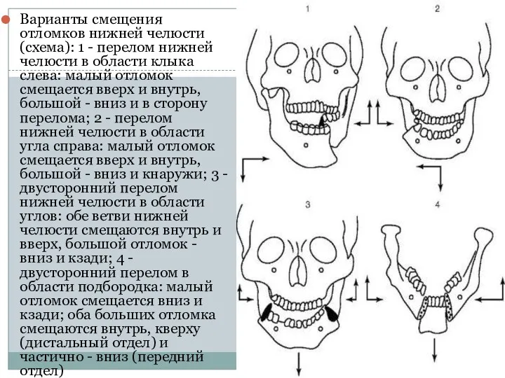 Варианты смещения отломков нижней челюсти (схема): 1 - перелом нижней