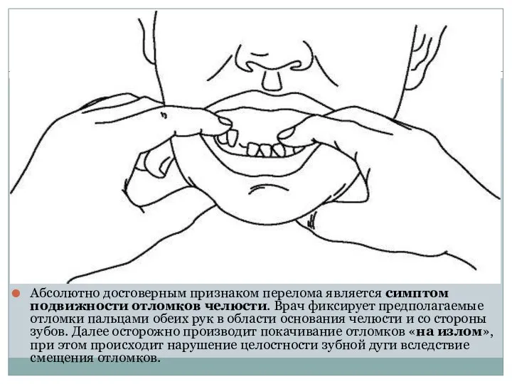 Абсолютно достоверным признаком перелома является симптом подвижности отломков челюсти. Врач