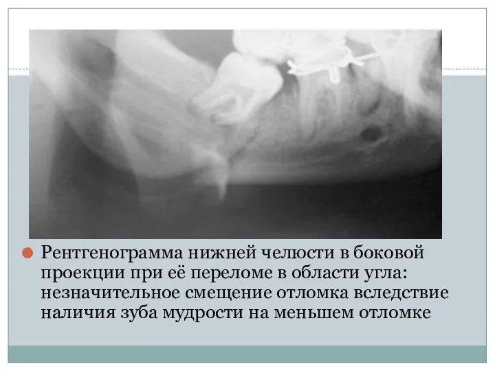 Рентгенограмма нижней челюсти в боковой проекции при её переломе в