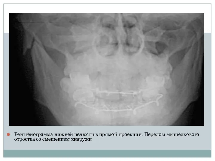 Рентгенограмма нижней челюсти в прямой проекции. Перелом мыщелкового отростка со смещением кнаружи