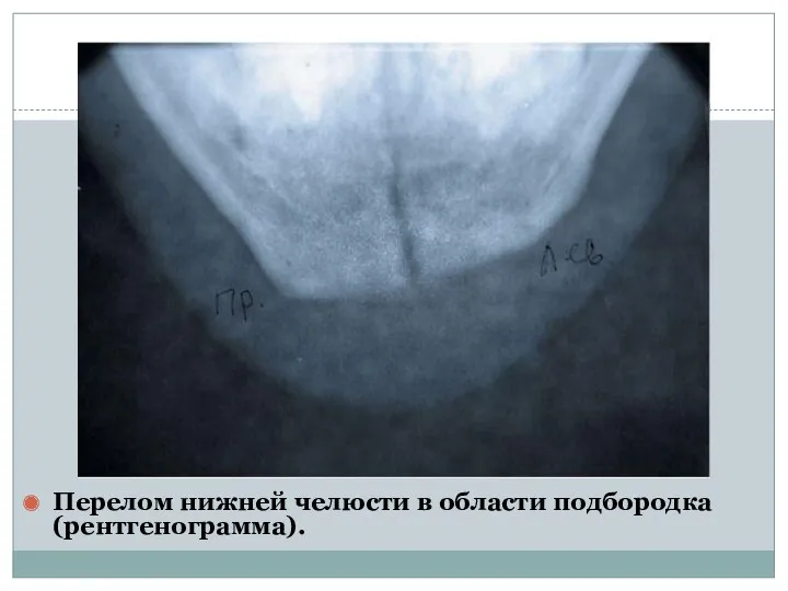 Перелом нижней челюсти в области подбородка (рентгенограмма).