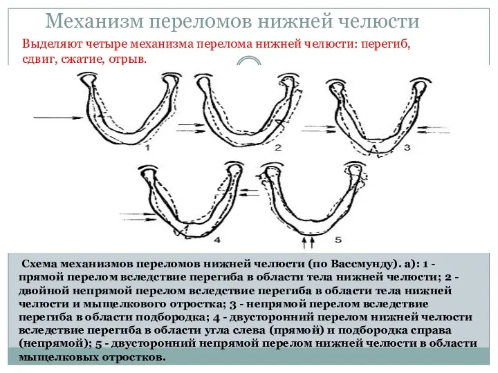 Механизм переломов нижней челюсти Выделяют четыре механизма перелома нижней челюсти: