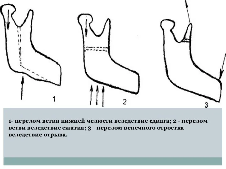 1- перелом ветви нижней челюсти вследствие сдвига; 2 - перелом