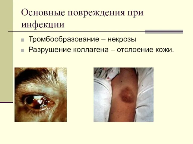 Основные повреждения при инфекции Тромбообразование – некрозы Разрушение коллагена – отслоение кожи.