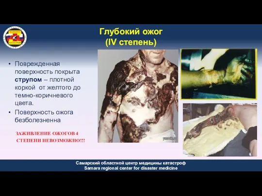 Глубокий ожог (IV степень) Поврежденная поверхность покрыта струпом – плотной