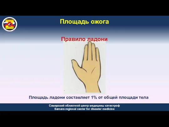 Площадь ладони составляет 1% от общей площади тела Площадь ожога Правило ладони