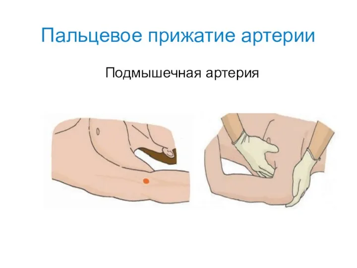 Пальцевое прижатие артерии Подмышечная артерия