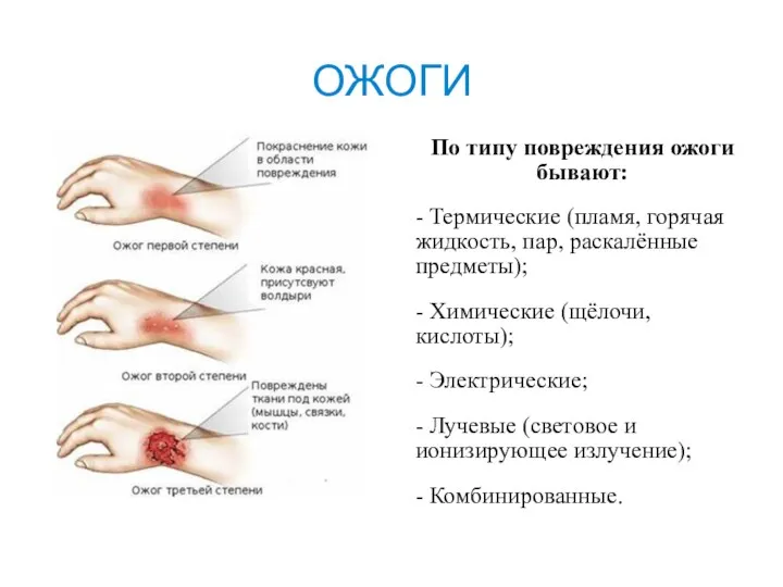 ОЖОГИ По типу повреждения ожоги бывают: - Термические (пламя, горячая