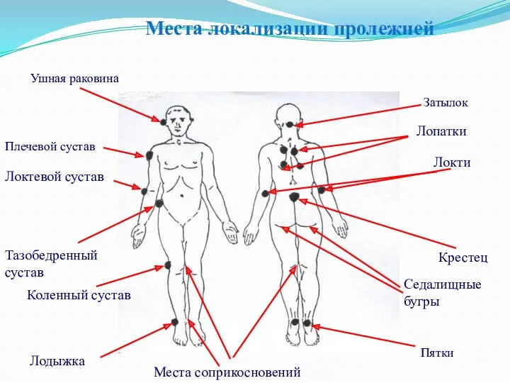 Места локализации пролежней Ушная раковина Плечевой сустав Локтевой сустав Тазобедренный