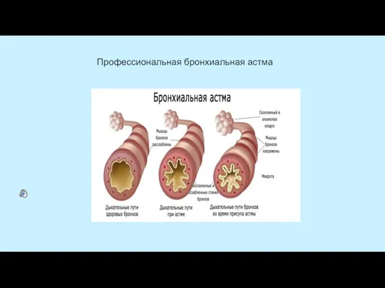 Профессиональная бронхиальная астма