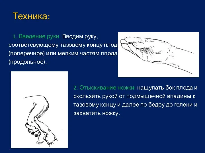 Техника: 1. Введение руки. Вводим руку, соответсвующему тазовому концу плода