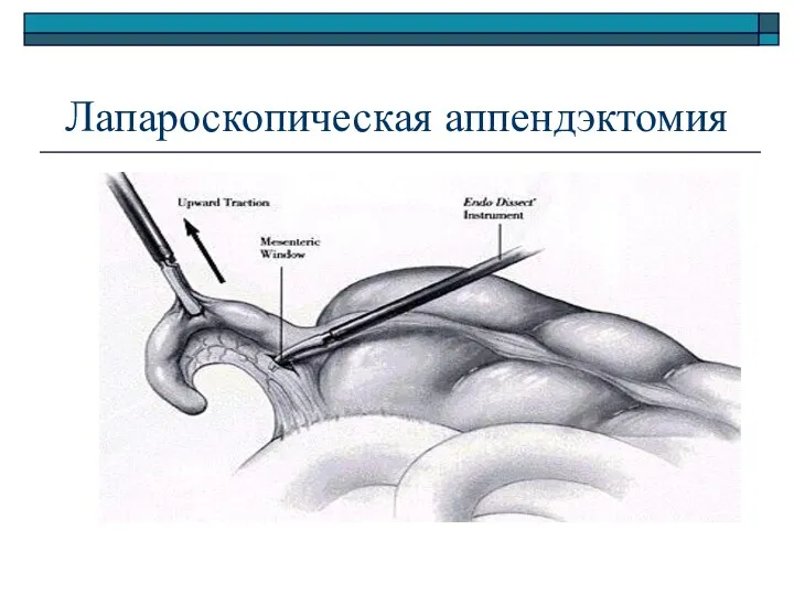 Лапароскопическая аппендэктомия