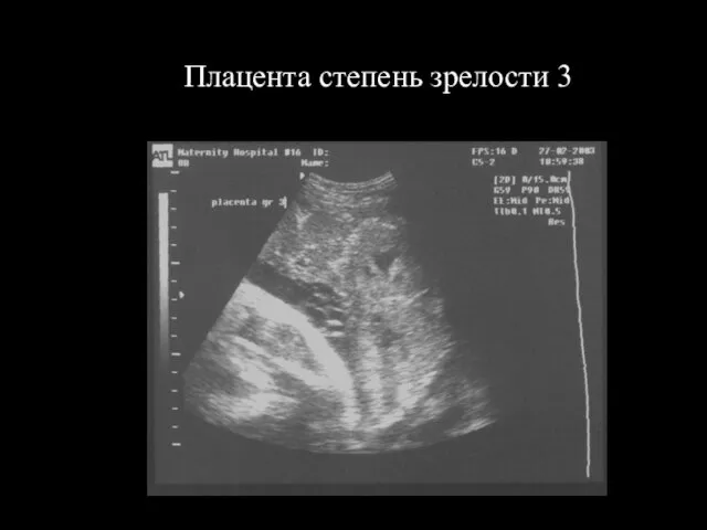 Плацента степень зрелости 3