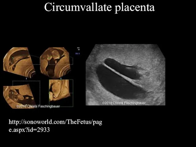 Circumvallate placenta http://sonoworld.com/TheFetus/page.aspx?id=2933