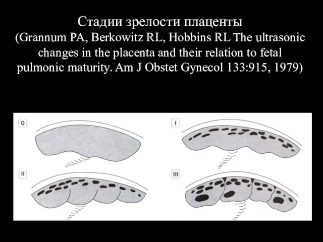 Стадии зрелости плаценты (Grannum PA, Berkowitz RL, Hobbins RL The