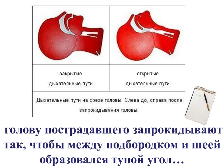 голову пострадавшего запрокидывают так, чтобы между подбородком и шеей образовался тупой угол…