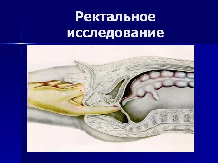 Ректальное исследование