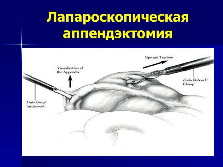 Лапароскопическая аппендэктомия