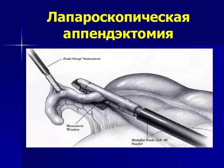 Лапароскопическая аппендэктомия