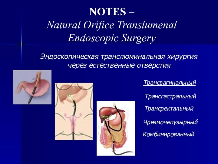 NOTES – Natural Orifice Translumenal Endoscopic Surgery Эндоскопическая транслюминальная хирургия