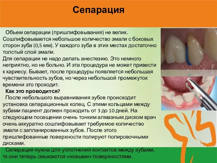 Сепарация Объем сепарации (пришлифовывания) не велик. Сошлифовывается небольшое количество эмали