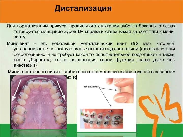 Дистализация Для нормализации прикуса, правильного смыкания зубов в боковых отделах