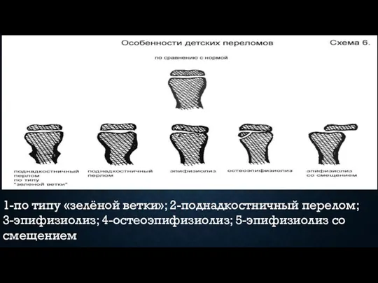 1-по типу «зелёной ветки»; 2-поднадкостничный перелом; 3-эпифизиолиз; 4-остеоэпифизиолиз; 5-эпифизиолиз со смещением