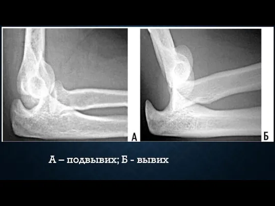 А – подвывих; Б - вывих