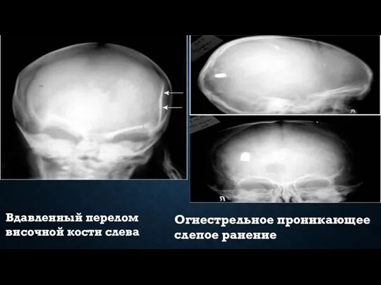 Вдавленный перелом височной кости слева Огнестрельное проникающее слепое ранение