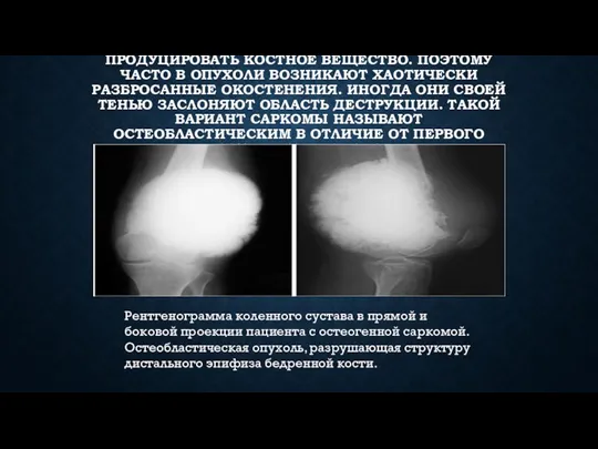 КЛЕТКИ ОСТЕОГЕННОЙ САРКОМЫ СПОСОБНЫ ПРОДУЦИРОВАТЬ КОСТНОЕ ВЕЩЕСТВО. ПОЭТОМУ ЧАСТО В