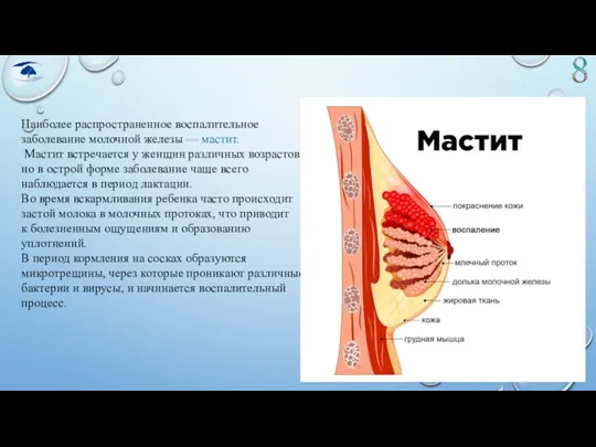 Наиболее распространенное воспалительное заболевание молочной железы — мастит. Мастит встречается