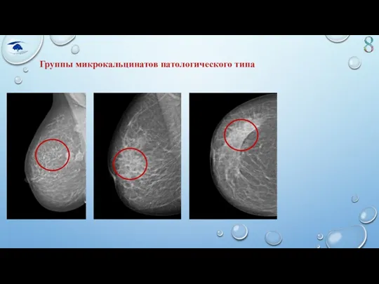 Группы микрокальцинатов патологического типа