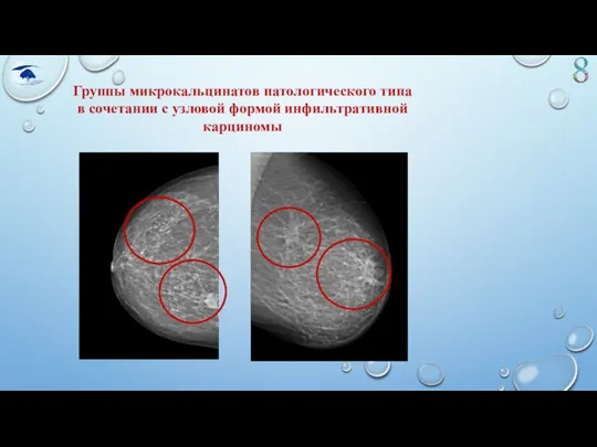 Группы микрокальцинатов патологического типа в сочетании с узловой формой инфильтративной карциномы