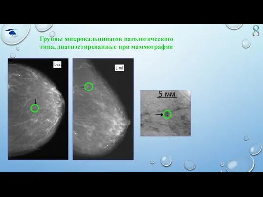 Группы микрокальцинатов патологического типа, диагностированные при маммографии