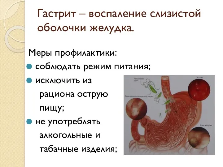 Гастрит – воспаление слизистой оболочки желудка. Меры профилактики: соблюдать режим