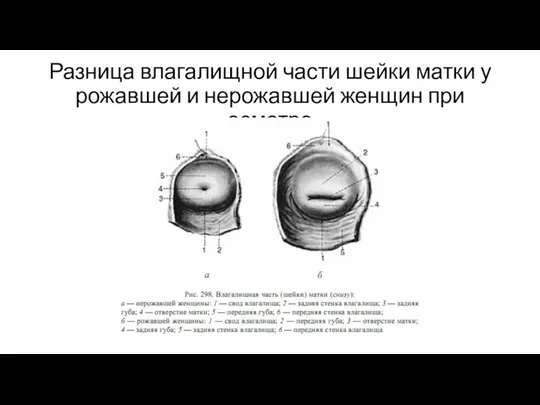 Разница влагалищной части шейки матки у рожавшей и нерожавшей женщин при осмотре