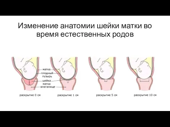 Изменение анатомии шейки матки во время естественных родов