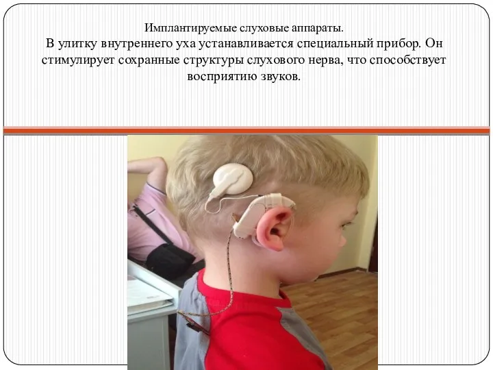 Имплантируемые слуховые аппараты. В улитку внутреннего уха устанавливается специальный прибор.