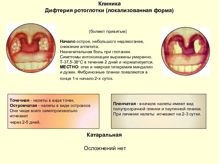 Клиника Дифтерия ротоглотки (локализованная форма) (болеют привитые) Начало острое, небольшого