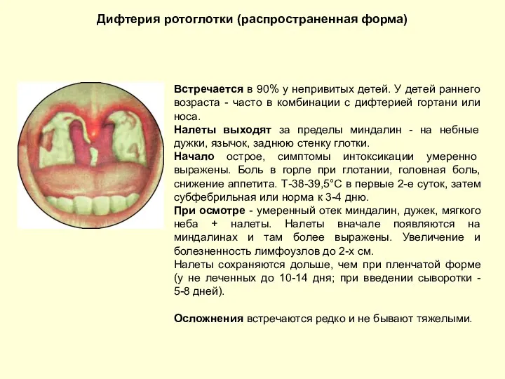 Дифтерия ротоглотки (распространенная форма) Встречается в 90% у непривитых детей.